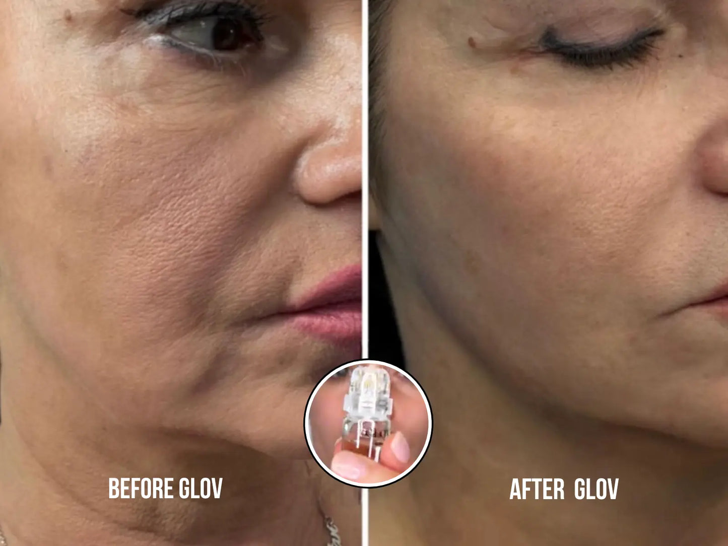 Glov Micro Infusion System